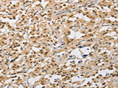 The image on the left is immunohistochemistry of paraffin-embedded Human thyroid cancer tissue using CSB-PA063322(AMZ2 Antibody) at dilution 1/40, on the right is treated with fusion protein. (Original magnification: ×200)