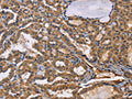 The image on the left is immunohistochemistry of paraffin-embedded Human thyroid cancer tissue using CSB-PA063633(EPHB6 Antibody) at dilution 1/50, on the right is treated with fusion protein. (Original magnification: ×200)