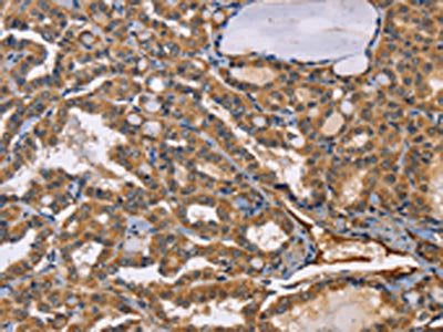 The image on the left is immunohistochemistry of paraffin-embedded Human thyroid cancer tissue using CSB-PA063633(EPHB6 Antibody) at dilution 1/50, on the right is treated with fusion protein. (Original magnification: ×200)