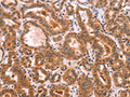 The image on the left is immunohistochemistry of paraffin-embedded Human thyroid cancer tissue using CSB-PA063661(NCEH1 Antibody) at dilution 1/80, on the right is treated with fusion protein. (Original magnification: ×200)