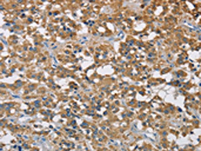The image on the left is immunohistochemistry of paraffin-embedded Human thyroid cancer tissue using CSB-PA063818(CST2 Antibody) at dilution 1/50, on the right is treated with fusion protein. (Original magnification: ×200)