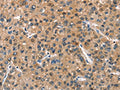 The image on the left is immunohistochemistry of paraffin-embedded Human liver cancer tissue using CSB-PA064362(ASB2 Antibody) at dilution 1/40, on the right is treated with fusion protein. (Original magnification: ×200)