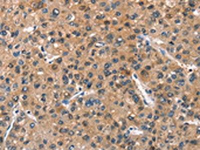 The image on the left is immunohistochemistry of paraffin-embedded Human liver cancer tissue using CSB-PA064362(ASB2 Antibody) at dilution 1/40, on the right is treated with fusion protein. (Original magnification: ×200)