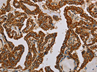 The image on the left is immunohistochemistry of paraffin-embedded Human thyroid cancer tissue using CSB-PA064548(NDUFS5 Antibody) at dilution 1/50, on the right is treated with fusion protein. (Original magnification: ×200)