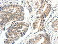 The image on the left is immunohistochemistry of paraffin-embedded Human colon cancer tissue using CSB-PA064607(FAM3A Antibody) at dilution 1/30, on the right is treated with fusion protein. (Original magnification: ×200)