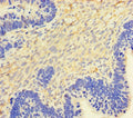 Immunohistochemistry of paraffin-embedded human ovarian cancer using CSB-PA06475A0Rb at dilution of 1:100