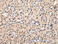 The image on the left is immunohistochemistry of paraffin-embedded Human liver cancer tissue using CSB-PA064912(MUC1(NT) Antibody) at dilution 1/20, on the right is treated with synthetic peptide. (Original magnification: ×200)