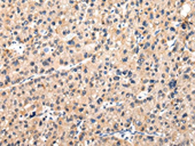The image on the left is immunohistochemistry of paraffin-embedded Human liver cancer tissue using CSB-PA064912(MUC1(NT) Antibody) at dilution 1/20, on the right is treated with synthetic peptide. (Original magnification: ×200)