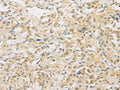 The image on the left is immunohistochemistry of paraffin-embedded Human thyroid cancer tissue using CSB-PA064938(FNTA Antibody) at dilution 1/30, on the right is treated with fusion protein. (Original magnification: ×200)