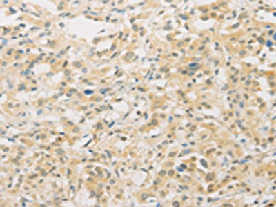 The image on the left is immunohistochemistry of paraffin-embedded Human thyroid cancer tissue using CSB-PA064938(FNTA Antibody) at dilution 1/30, on the right is treated with fusion protein. (Original magnification: ×200)