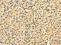 The image on the left is immunohistochemistry of paraffin-embedded Human prostate cancer tissue using CSB-PA065296(DNASE1 Antibody) at dilution 1/25, on the right is treated with fusion protein. (Original magnification: ×200)