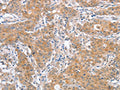 The image on the left is immunohistochemistry of paraffin-embedded Human gastic cancer tissue using CSB-PA065886(ATG12 Antibody) at dilution 1/40, on the right is treated with fusion protein. (Original magnification: ×200)