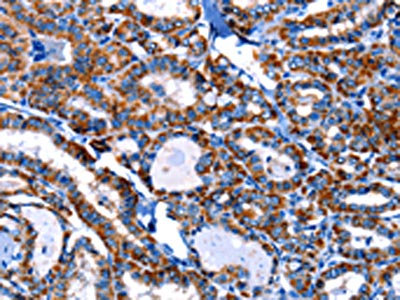The image on the left is immunohistochemistry of paraffin-embedded Human thyroid cancer tissue using CSB-PA066101(ITGA7 Antibody) at dilution 1/10, on the right is treated with synthetic peptide. (Original magnification: ×200)
