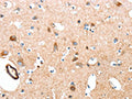 The image on the left is immunohistochemistry of paraffin-embedded Human brain tissue using CSB-PA066208(AARS Antibody) at dilution 1/50, on the right is treated with synthetic peptide. (Original magnification: ×200)