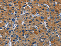 The image on the left is immunohistochemistry of paraffin-embedded Human liver cancer tissue using CSB-PA066219(MSH5 Antibody) at dilution 1/30, on the right is treated with fusion protein. (Original magnification: ×200)