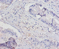 Immunohistochemistry of paraffin-embedded human colon cancer using CSB-PA06635A0Rb at dilution of 1:100