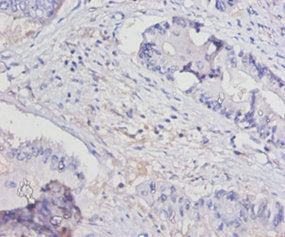 Immunohistochemistry of paraffin-embedded human colon cancer using CSB-PA06635A0Rb at dilution of 1:100