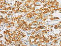 The image on the left is immunohistochemistry of paraffin-embedded Human thyroid cancer tissue using CSB-PA066473(IDH3G Antibody) at dilution 1/30, on the right is treated with fusion protein. (Original magnification: ×200)
