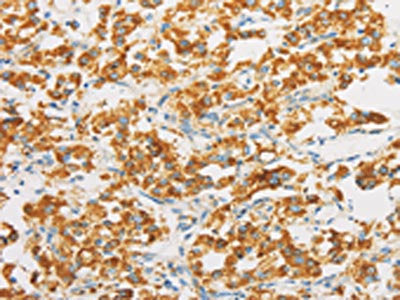 The image on the left is immunohistochemistry of paraffin-embedded Human thyroid cancer tissue using CSB-PA066473(IDH3G Antibody) at dilution 1/30, on the right is treated with fusion protein. (Original magnification: ×200)