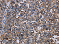 The image on the left is immunohistochemistry of paraffin-embedded Human ovarian cancer tissue using CSB-PA066576(LDOC1 Antibody) at dilution 1/50, on the right is treated with fusion protein. (Original magnification: ×200)