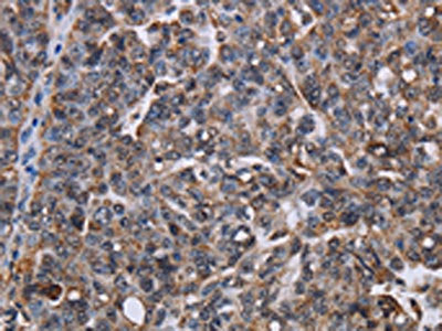 The image on the left is immunohistochemistry of paraffin-embedded Human ovarian cancer tissue using CSB-PA066576(LDOC1 Antibody) at dilution 1/50, on the right is treated with fusion protein. (Original magnification: ×200)