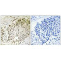 Immunohistochemistry analysis of paraffin-embedded human lung carcinoma tissue using RFX2 antibody.
