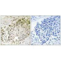Immunohistochemistry analysis of paraffin-embedded human lung carcinoma tissue using RFX2 antibody.