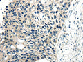 The image on the left is immunohistochemistry of paraffin-embedded Human esophagus cancer tissue using CSB-PA066718(CYP19A1 Antibody) at dilution 1/30, on the right is treated with synthetic peptide. (Original magnification: ×200)