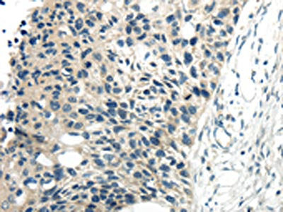 The image on the left is immunohistochemistry of paraffin-embedded Human esophagus cancer tissue using CSB-PA066718(CYP19A1 Antibody) at dilution 1/30, on the right is treated with synthetic peptide. (Original magnification: ×200)