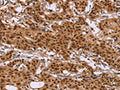 The image on the left is immunohistochemistry of paraffin-embedded Human gastic cancer tissue using CSB-PA066793(CTNNBL1 Antibody) at dilution 1/50, on the right is treated with fusion protein. (Original magnification: ×200)