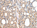 The image on the left is immunohistochemistry of paraffin-embedded Human thyroid cancer tissue using CSB-PA066975(UQCRC1 Antibody) at dilution 1/20, on the right is treated with fusion protein. (Original magnification: ×200)