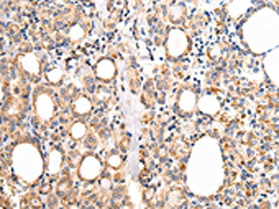 The image on the left is immunohistochemistry of paraffin-embedded Human thyroid cancer tissue using CSB-PA066975(UQCRC1 Antibody) at dilution 1/20, on the right is treated with fusion protein. (Original magnification: ×200)