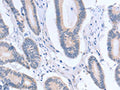 The image on the left is immunohistochemistry of paraffin-embedded Human colon cancer tissue using CSB-PA067150(ACTR3B Antibody) at dilution 1/15, on the right is treated with fusion protein. (Original magnification: ×200)