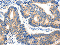 The image on the left is immunohistochemistry of paraffin-embedded Human colon cancer tissue using CSB-PA067502(HDC Antibody) at dilution 1/20, on the right is treated with fusion protein. (Original magnification: ×200)