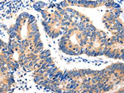 The image on the left is immunohistochemistry of paraffin-embedded Human colon cancer tissue using CSB-PA067502(HDC Antibody) at dilution 1/20, on the right is treated with fusion protein. (Original magnification: ×200)
