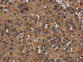 The image on the left is immunohistochemistry of paraffin-embedded Human liver cancer tissue using CSB-PA067561(NDUFS8 Antibody) at dilution 1/50, on the right is treated with fusion protein. (Original magnification: ×200)