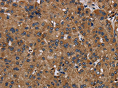 The image on the left is immunohistochemistry of paraffin-embedded Human liver cancer tissue using CSB-PA067561(NDUFS8 Antibody) at dilution 1/50, on the right is treated with fusion protein. (Original magnification: ×200)