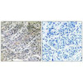 Immunohistochemistry analysis of paraffin-embedded human lung carcinoma tissue using BRP44 antibody.