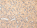 The image on the left is immunohistochemistry of paraffin-embedded Human liver cancer tissue using CSB-PA068096(COL8A2 Antibody) at dilution 1/20, on the right is treated with synthetic peptide. (Original magnification: ×200)