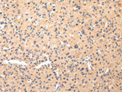 The image on the left is immunohistochemistry of paraffin-embedded Human liver cancer tissue using CSB-PA068096(COL8A2 Antibody) at dilution 1/20, on the right is treated with synthetic peptide. (Original magnification: ×200)