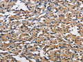 The image on the left is immunohistochemistry of paraffin-embedded Human thyroid cancer tissue using CSB-PA068175(CBY1 Antibody) at dilution 1/60, on the right is treated with fusion protein. (Original magnification: ×200)