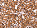 The image on the left is immunohistochemistry of paraffin-embedded Human thyroid cancer tissue using CSB-PA068193(ARL4A Antibody) at dilution 1/60, on the right is treated with fusion protein. (Original magnification: ×200)