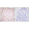 Immunohistochemical analysis of paraffin-embedded human breast carcinoma tissue using RCC1 antibody.