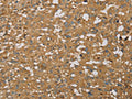The image on the left is immunohistochemistry of paraffin-embedded Human thyroid cancer tissue using CSB-PA068521(AHSG Antibody) at dilution 1/60, on the right is treated with fusion protein. (Original magnification: ×200)