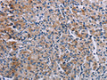 The image on the left is immunohistochemistry of paraffin-embedded Human prostate cancer tissue using CSB-PA068591(KDM4D Antibody) at dilution 1/60, on the right is treated with fusion protein. (Original magnification: ×200)