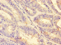 Immunohistochemistry of paraffin-embedded human endometrial cancer using CSB-PA06879A0Rb at dilution of 1:100
