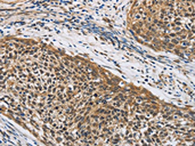 The image on the left is immunohistochemistry of paraffin-embedded Human cervical cancer tissue using CSB-PA069370(LEF1 Antibody) at dilution 1/20, on the right is treated with fusion protein. (Original magnification: ×200)