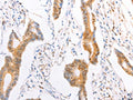 The image on the left is immunohistochemistry of paraffin-embedded Human colon cancer tissue using CSB-PA069375(TRAF5 Antibody) at dilution 1/20, on the right is treated with fusion protein. (Original magnification: ×200)