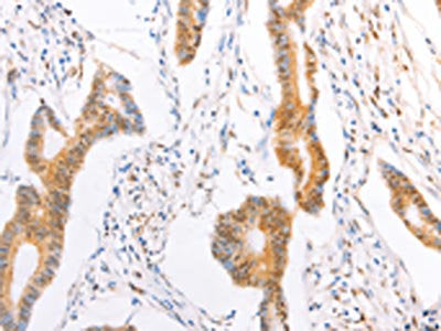 The image on the left is immunohistochemistry of paraffin-embedded Human colon cancer tissue using CSB-PA069375(TRAF5 Antibody) at dilution 1/20, on the right is treated with fusion protein. (Original magnification: ×200)