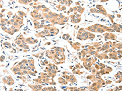 The image on the left is immunohistochemistry of paraffin-embedded Human breast cancer tissue using CSB-PA069429(ADCK1 Antibody) at dilution 1/40, on the right is treated with fusion protein. (Original magnification: ×200)
